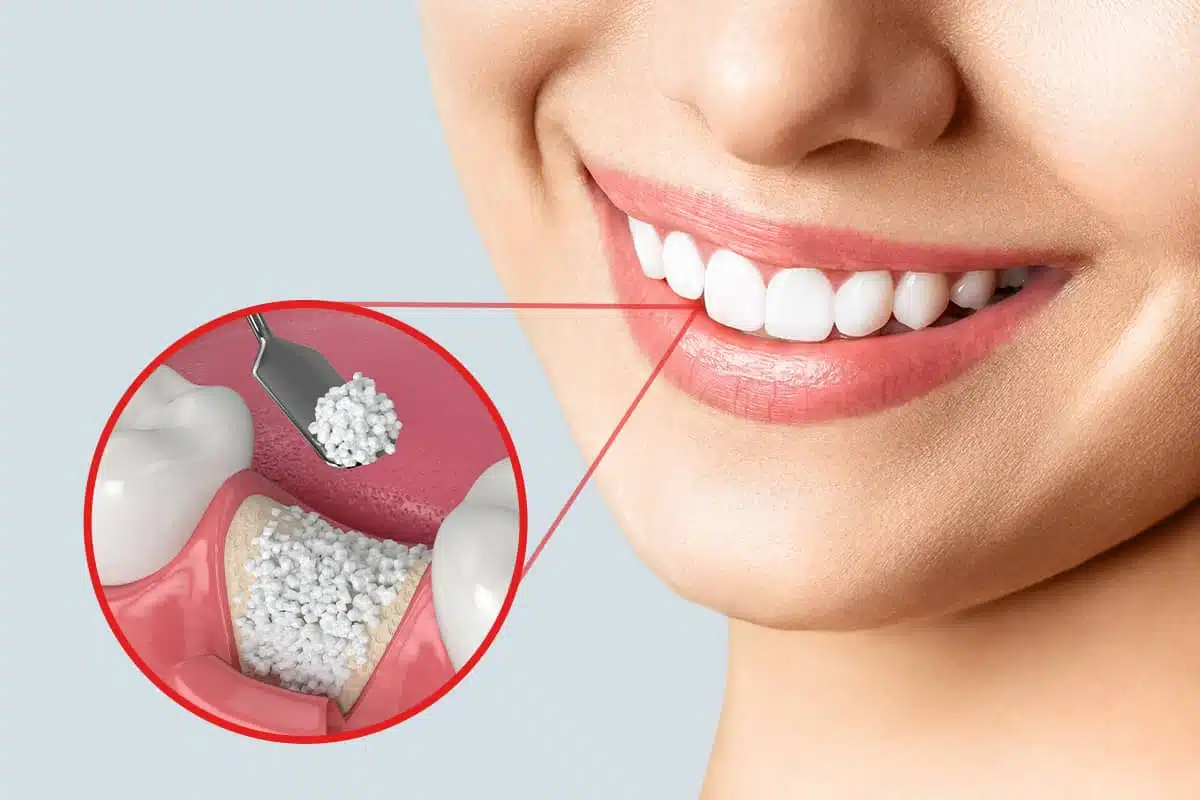 Bone Grafting