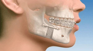 Corrective Jaw Surgery